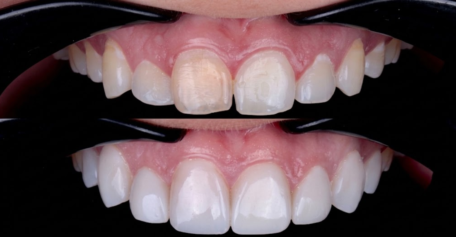 Veneers Before and After Real Patient Transformations1